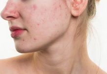 Yüzdeki Sivilce İzleri Nasıl Geçer yüzdeki sivilce izleri nasıl geçer