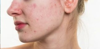 Yüzdeki Sivilce İzleri Nasıl Geçer yüzdeki sivilce izleri nasıl geçer