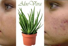 Aloe Vera Sivilce İçin Nasıl Kullanılır? aloe vera sivilce için nasıl kullanılır