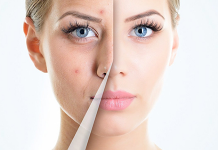 Sivilce Nasıl Geçer 1 Günde Evde sivilce nasıl geçer 1 günde evde