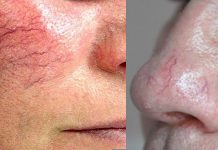 Yüzdeki Kılcal Damarlar İçin Krem yüzdeki kılcal damarlar için krem