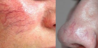 Yüzdeki Kılcal Damarlar İçin Krem yüzdeki kılcal damarlar için krem