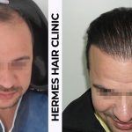 hermes-hair-clinic-sac-ekimi