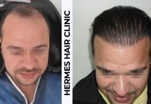 HERMEST’de Saç Ekimi Yaptıran Muhabirimizin Yorumları ve Sonuçları Hermes Hair Clinic Saç ekimi