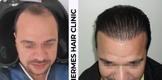 HERMEST’de Saç Ekimi Yaptıran Muhabirimizin Yorumları ve Sonuçları Hermes Hair Clinic Saç ekimi