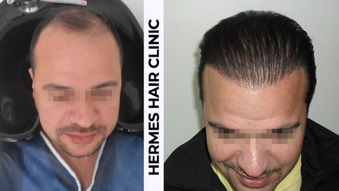 Hermes Hair Clinic Saç ekimi