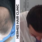 hermes-hair-clinic-sac-ekimi-sonucu