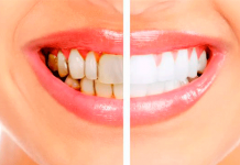 Feridun Kunak Diş Taşı Temizliği feridun kunak diş taşı temizliği