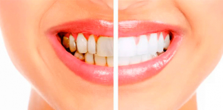 Feridun Kunak Diş Taşı Temizliği feridun kunak diş taşı temizliği