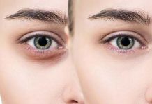 Hindistan Cevizi Yağı Göz Altı Morlukları Hindistan Cevizi Yağı Göz Altı Morlukları