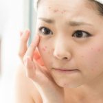 sivilceler-nasil-ortaya-cikar