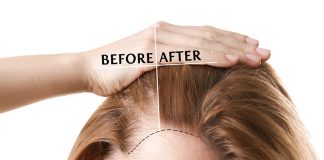 Nimclinic Anlatıyor: Uzun ve Tıraşsız Saç Ekimi Nedir? nimclinic kadınlarda saç ekimi